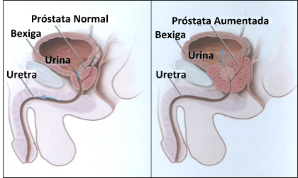 Hiperplasia Benigna da próstata imagem