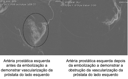 embolização prostatica depois embolização prostatica depois