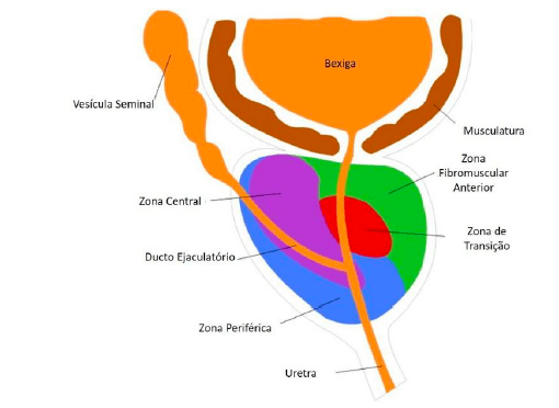 disfuncao eretil hiperplasia benigna da prostata