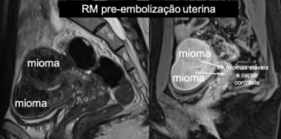 fibromiomas uterinos antes
