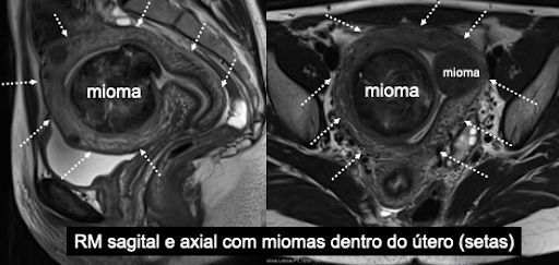 miomas uterinos antes