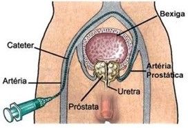 Hiperplasia Benigna da Próstata - Embolização Prostática