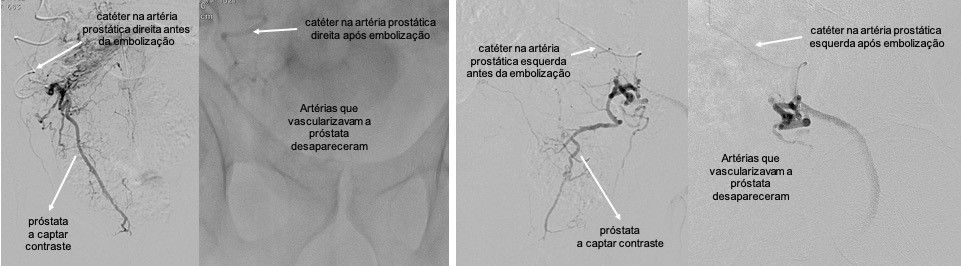 Hiperplasia Benigna da Próstata - Embolização Prostática