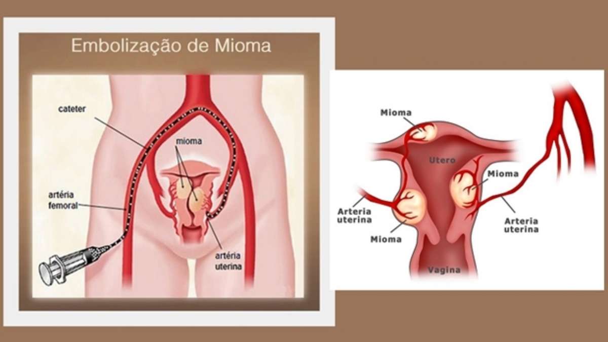 embolização uterina - fibromiomas