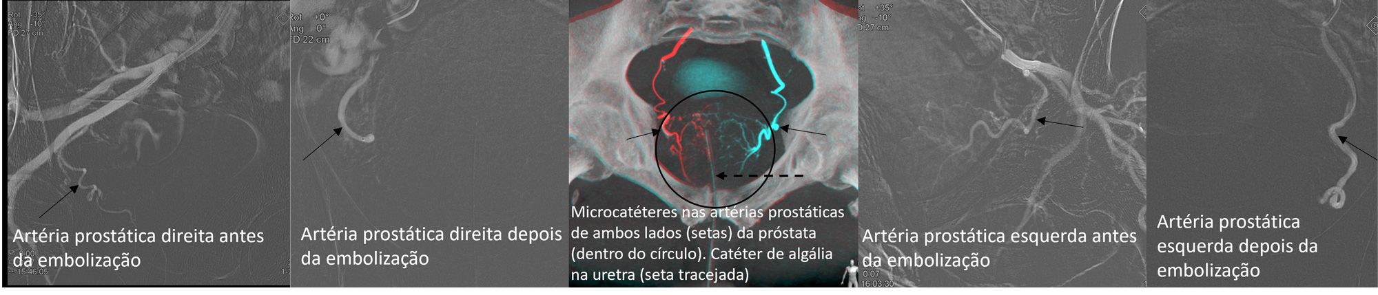 Testemunho Hiperplasia Benigna da Próstata - Embolização Prostática 2