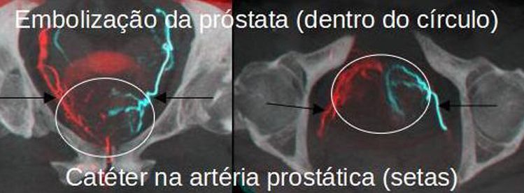 Fernando - Embolização Prostática