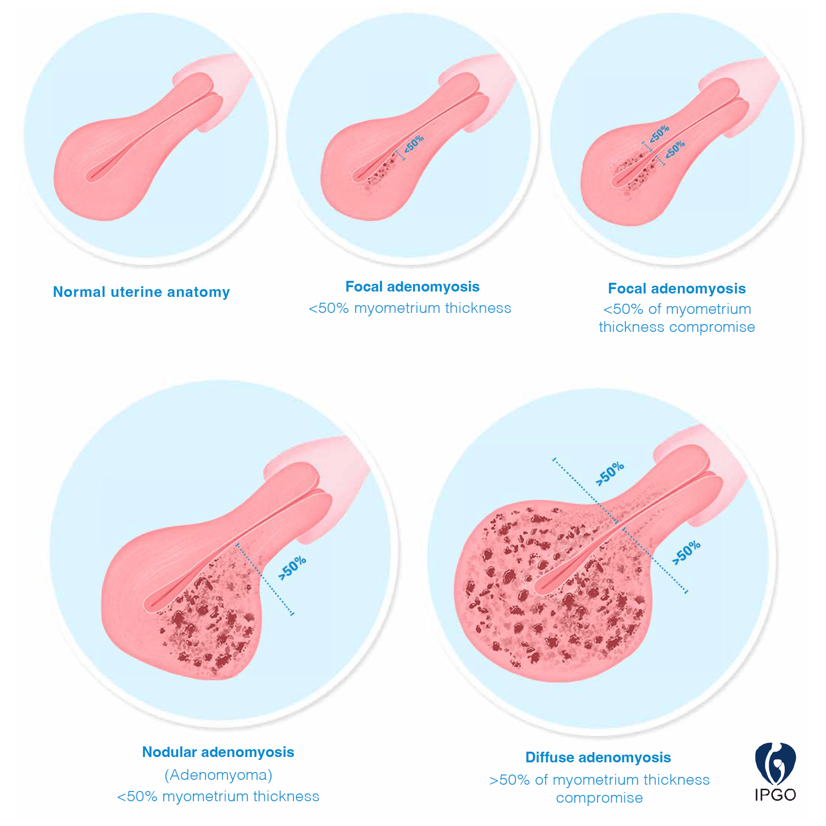 adenomyosis