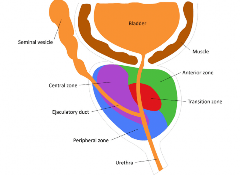 Benign Prostatic Hyperplasia - What Is It, How It Happens, Treatment