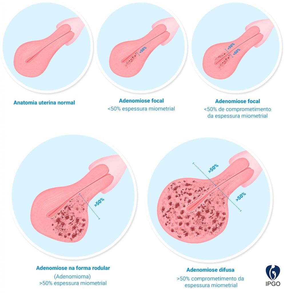 Adenomiose: conheça os sintomas